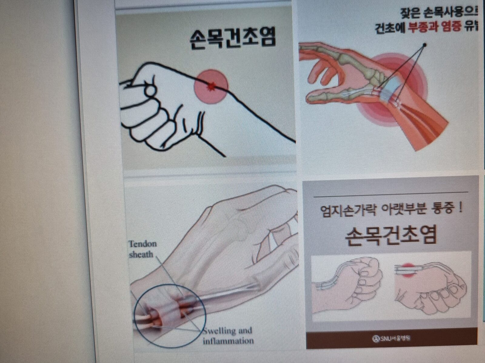 손목 건초염.jpg