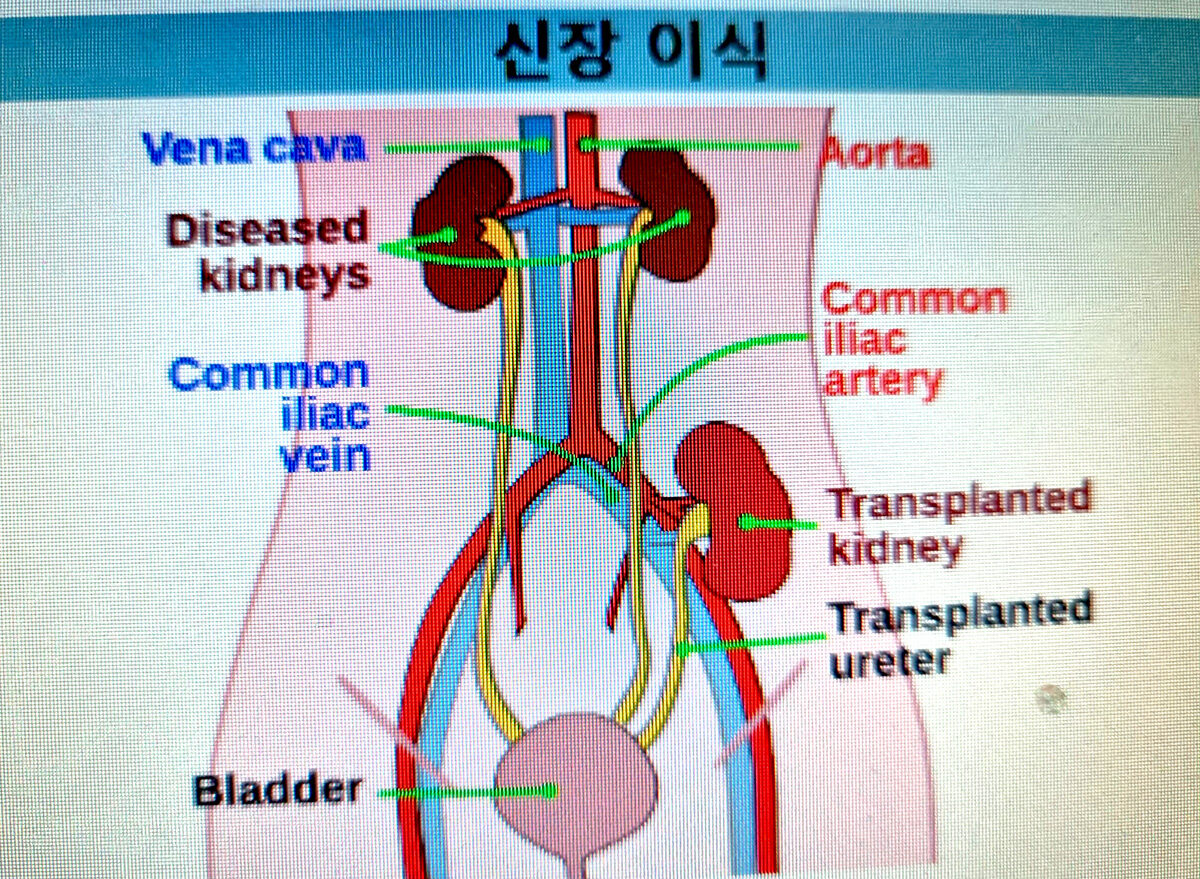 신장이식2.jpg